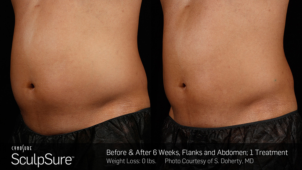 sculpsure before and after